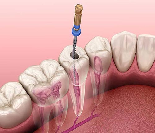 root canal treatment